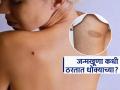 जन्मापासून शरीरावर असलेल्या लाल काळ्या खुणा- चट्टे घातक असतात का? पाहा काय त्याचा अर्थ.. - Marathi News | Birthmarks Cause and Facts : Why do birthmarks occur on body and when do they become dangerous | Latest sakhi News at Lokmat.com