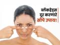 चेहऱ्याचं सौंदर्य कमी करणारे ब्लॅकहेड्स 'असे’ करा छूमंतर, पार्लरला जाण्याचीही नाही गरज! - Marathi News | Home remedies to get rid of blackheads naturally | Latest sakhi News at Lokmat.com