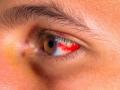 सावधान! Bleeding Eye व्हायरस म्हणजे काय? ८ दिवसांत होतो रुग्णाचा मृत्यू, 'ही' आहेत लक्षणं - Marathi News | what is bleeding eye virus know its symptoms cause and prevention tips | Latest sakhi News at Lokmat.com