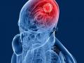 World Brain Tumour Day: ब्रेन ट्युमरची सुरुवातीची लक्षणे, काय आहेत ही लक्षणे? - Marathi News | World Brain Tumour Day: 10 Early Symptoms of Brain Tumors, What are these symptoms? | Latest health News at Lokmat.com