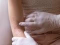 आधीच तापाची साथ त्यात पुरळचा त्रास ! डॉक्टरांचा सल्ला घ्या  - Marathi News | Already with fever, there is trouble with rash! | Latest mumbai News at Lokmat.com