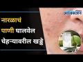 नारळाचं पाणी कसे घालवेल चेहऱ्यावरील खड्डे? Coconut Water Remove Pits On The Face | Lokmat Oxygen - Marathi News | How to remove coconut water pits on the face? Coconut Water Remove Pits On The Face | Lokmat Oxygen | Latest oxygen Videos at Lokmat.com