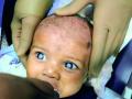 नागपुरात दोन महिन्याच्या बाळाला मोतीबिंदू  - Marathi News | Cataract for a two-month-old baby in Nagpur | Latest nagpur News at Lokmat.com