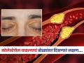डोळ्यांमध्ये दिसणारा 'हा' बदल म्हणजे कोलेस्टेरॉल वाढल्याचं लक्षण, हयगय केली तर जीवाला धोका - Marathi News | These are the high cholesterol symptoms seen in the eyes | Latest sakhi News at Lokmat.com