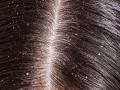 डॅँड्रफच्या समस्येने त्रस्त आहात? - Marathi News | Are you troubled with the problem of Dandruff? | Latest beauty News at Lokmat.com