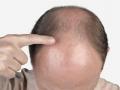 ​OMG : डोक्याला टक्कल पडलीय, करा १० घरगुती उपाय ! - Marathi News | OMG: Headache baldness, 10 home remedies! | Latest health News at Lokmat.com