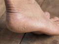 ​पायांना भेगा पडताहेत..! - Marathi News | Feet falling apart! | Latest beauty News at Lokmat.com
