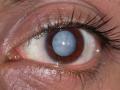 मोतीबिंदू घालवण्यासाठी नवे औषध - Marathi News | New drug to remove cataracts | Latest beauty News at Lokmat.com