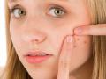 या कारणाने होतात पिंंपल्स ! - Marathi News | Pimples are due to this reason! | Latest beauty News at Lokmat.com