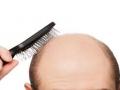 ​.. तर टक्कल पडणार नाही! - Marathi News | If you do not have any baldness! | Latest beauty News at Lokmat.com