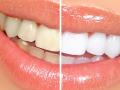 BEAUTY : ​घरगुती उपायांनी घालवा दाताचा पिवळेपणा ! - Marathi News | BEAUTY: Domestic solution is yellow veneer! | Latest health News at Lokmat.com
