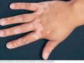 आजार संसर्गजन्य नाही; गैरसमज मात्र फार - Marathi News | Disease is not infectious; The misconception is very much | Latest solapur News at Lokmat.com