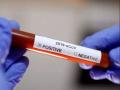 Corona Vaccination: दुसऱ्या डोसनंतर वैद्यकीय विद्यार्थ्याला कोरोना - Marathi News | medical student corona positive after the second dose of Corona Vaccine | Latest mumbai News at Lokmat.com