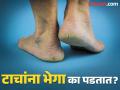 टाचांना भेगा पडल्याने आहात हैराण? जाणून घ्या कारण तेव्हाच कराल योग्य उपाय! - Marathi News | Cracked Heels: Common Causes To Be Aware Of! | Latest beauty Photos at Lokmat.com