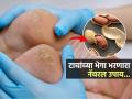 टाचांना भेगा पडल्या असतील तर करा ‘असा’ भुईमुगाच्या शेंगांच्या टरफलाचा उपाय- पाहा फरक आपोआप - Marathi News | How peanut shell can help heal dry and cracked feet | Latest sakhi News at Lokmat.com