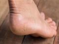 टाचांच्या भेगांपासून सुटका करायची आहे?; 'हे' 5 उपाय करतील मदत - Marathi News | Effective home remedies to heal cracked heels | Latest beauty Photos at Lokmat.com