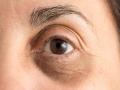 'या' तीन घरगुती उपायांनी गायब होतील डार्क सर्कल्स; असा करा वापर - Marathi News | Dark circles treatment how to reduce dark circles home remedies for dark circles | Latest beauty News at Lokmat.com