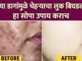 काळ्या डागांवर घरगुती उपाय| | How To get Rid Dark Spots On Face | Dark Spots Home Remedy - Marathi News | Home Remedies for Blackheads | | How To Get Rid Dark Spots On Face | Dark Spots Home Remedy | Latest beauty Videos at Lokmat.com