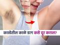 काखेतील काळ्या डागांमुळे स्लीव्हजलेस ड्रेस घालता येत नाही? करा 'हे' सोपे उपाय, डाग होतील गायब - Marathi News | Dermatologist tells how to get rid of dark underarm patches | Latest sakhi News at Lokmat.com