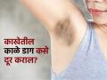 काखेतील काळपटपणामुळे स्लीव्ह्जलेस ड्रेस घालता येत नाही? पाहा डॉक्टरांनी सांगितलेले हे उपाय... - Marathi News | Dermatologist tells how to clean dark underarms | Latest sakhi News at Lokmat.com