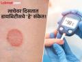 डायबिटीसचे संकेत असू शकतात त्वचेच्या या समस्या, दुर्लक्ष करणं पडू शकतं महागात! - Marathi News | High blood sugar can affects skin health | Latest health Photos at Lokmat.com