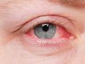 Eye Infection: खेड तालुक्यात १० हजारांहून अधिक जणांना आले डोळे; आळंदीत सर्वाधिक रुग्ण - Marathi News | More than 10,000 people lost their lives in Khed Taluka Most patients in Alandi | Latest pune News at Lokmat.com