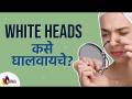 व्हाईट हेड्स कोणाला होऊ शकतात आणि त्यावरील उपाय | Home Remedy for white Heads | Lokmat Sakhi - Marathi News | Who can get white heads and the solution | Home Remedy for white Heads | Lokmat Sakhi | Latest oxygen Videos at Lokmat.com