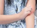 उन्हाळ्यात मुलांना खूप घामोळ्या होतात? तज्ज्ञ सांगतात 5 सोपे उपाय... - Marathi News | | Latest sakhi News at Lokmat.com