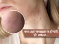 पिंपल्स नाही तुमच्या चेहऱ्यावरची ‘ही’ लक्षणं आहेत अधिक त्रासदायक, पाहा हा कोणता आजार - Marathi News | Fungal acne increases in the rain know the causes and symptoms | Latest sakhi News at Lokmat.com