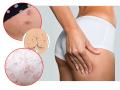 How to Remove Dark Spots on Hips : हिप्सवर बारीक दाणे, काळे डाग पडलेत? फक्त ४ उपाय, हिप्सवरील काळपट डाग कायमचे होतील दूर - Marathi News | How to Remove Dark Spots on Hips : 4 best way to get rid of dark spots and hyperpigmentation from buttocks | Latest sakhi News at Lokmat.com
