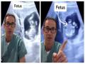 Doctors find foetus inside womans liver : बापरे! पोटाऐवजी महिलेच्या लिव्हरमध्ये दिसलं बाळ; अल्ट्रासाउंड रिपोर्ट पाहून डॉक्टर हादरले - Marathi News | Doctors find foetus inside canadian womans liver in extremely rare pregnancy | Latest sakhi News at Lokmat.com