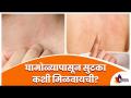 घामोळ्यांपासून सुटका कशी करायची? Simple Home Remedies For Prickly Heat | Rashes In Summer - Marathi News | How to get rid of sweat? Simple Home Remedies For Prickly Heat | Rashes In Summer | Latest oxygen Videos at Lokmat.com