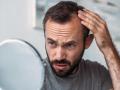 Hair loss in Men: तरुण वयातच टक्कल पडायला सुरुवात होते, पुरुषांच्या केसगळतीची आहेत ही चिंताजनक कारणं - Marathi News | hair fall in men causes and remedies | Latest health News at Lokmat.com