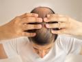 Hair loss: एन पंचवीशीतच टक्कल पडण्याची समस्या तुमचं तारुण्य हिरावून घेतेय, वेळीच करा हे उपाय - Marathi News | simple tips to prevent hair loss in men | Latest health News at Lokmat.com