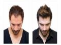 केशप्रत्यारोपणाकडे वाढतोय कल - Marathi News | Moving towards hair transplantation | Latest health News at Lokmat.com