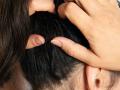 पावसाळ्यात डोक्याला खाज सुटते, उवा-लिखा झाल्या? ५ सोपे उपाय - केसांच्या समस्या होतील दूर - Marathi News | itchy scalp remedies in monsoon how to get rid of lice naturally hair care tips for rainy season | Latest sakhi News at Lokmat.com