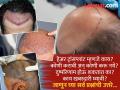 हेअर ट्रांसप्लांटमुळे दोघांचा मृत्यू; ही सर्जरी खरंच सुरक्षित आहे का? जाणून घ्या सविस्तर माहिती... - Marathi News | Hair Transplant Surgery: Two people died due to hair transplant; Is this surgery really safe? When can it be dangerous? Know... | Latest health Photos at Lokmat.com