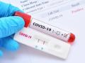Corona virus : पुणे शहरात मंगळवारी २४१ नवीन कोरोनाबाधित ; २२ रुग्णांचा मृत्यू  - Marathi News | Corona virus : 241 new corona affected in pune city on tuesday ; 22 died | Latest pune News at Lokmat.com