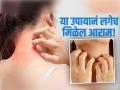 उन्हाळ्यात त्वचेचे आजार वाढतात, त्वचेची खाज लगेच दूर करतो 'हा' नॅचरल उपाय - Marathi News | Use neem water to get rid of skin itchiness | Latest sakhi News at Lokmat.com