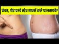 कमरेवर दिसणारे स्ट्रेच मार्क्स लूक बिघडवतात? | How To Reduce Stretch Marks | DIY Home Remedies - Marathi News | Do stretch marks on the waist spoil the look? | How To Reduce Stretch Marks | DIY Home Remedies | Latest health Videos at Lokmat.com