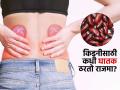 नाव किडनी बीन्स पण किडनीसाठी मात्र ठरु शकतो घातक, पाहा राजमा खाण्याचे नियम-पचेलही नीट - Marathi News | Rajma side effects : If you have any kidney disease avoid eating kidney beans | Latest sakhi News at Lokmat.com