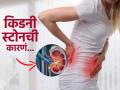 महिलांमध्ये किडनी स्टोनची दिसतात 'ही' लक्षणं, जाणून घ्या कारणं आणि काही घरगुती उपाय! - Marathi News | Common symptoms of kidney stones in women | Latest sakhi News at Lokmat.com