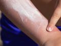 मुलांचा हात भाजला- चटका बसला? पटकन करा ४ उपाय - आग होईल कमी - Marathi News | quick home remedies for child hand burn how to reduce burning sensation after burn naturally | Latest sakhi News at Lokmat.com