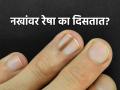 नखांवर पांढऱ्या, काळ्या रेषा दिसण्याची कारणं काय? दुर्लक्ष करणं पडेल महागात... - Marathi News | What do the lines on nails indicate know the reasons | Latest sakhi News at Lokmat.com