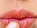 थंडीत ओठ फुटतात, रक्त येतं, भेगाही पडतात? ५ उपाय-हिवाळ्यातही ओठ राहतील मऊमुलायम गुलाबी - Marathi News | Easy tips to take care of lips in winter | Latest sakhi News at Lokmat.com