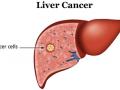 मृत्यूचे पाचवे कारण लिव्हर कॅन्सर  : डॉ. गौरव गुप्ता - Marathi News | The fifth reason for death is Liver Cancer: Dr. Gaurav Gupta | Latest nagpur News at Lokmat.com