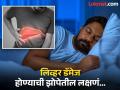 रात्री झोपताना दिसतात लिव्हर खराब होण्याचे 'हे' संकेत, 90 टक्के लोक याकडे करतात दुर्लक्ष! - Marathi News | Liver Damage Warning signs visible during sleeping people often ignore these symptoms | Latest health News at Lokmat.com