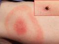 केवळ १५ मिनिटात Lyme Disease चं होणार निदान, जाणून घ्या काय आहे हा आजार? - Marathi News | You should know about Lyme disease and its symptoms | Latest health News at Lokmat.com