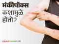 Monkey Pox : प्राण्यांपासून माणसांत संसर्ग होणारा आजार मंकीपॉक्स; काय आहेत लक्षणे? कशी घ्याल काळजी? - Marathi News | Monkey Pox : Monkeypox is a disease transmitted from animals to humans; what are the symptoms? How to take care of it? | Latest agriculture News at Lokmat.com