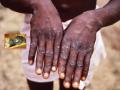 Monkeypox virus: मंकीपॉक्स म्हणजे काय? जाणून घ्या आजाराची लक्षणं - Marathi News | Monkeypox virus: What is a monkeypox? Know the symptoms of the disease | Latest health Photos at Lokmat.com